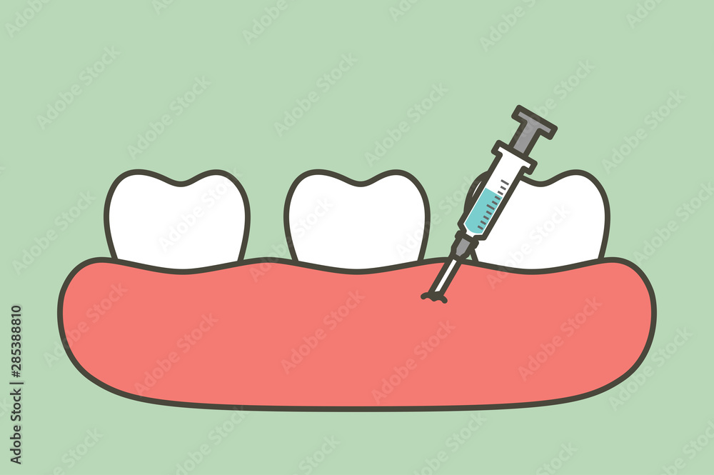 dental injection for tooth extraction, syringe and anesthetizing