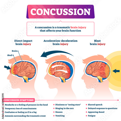 Concussion vector illustration. Labeled educational post head trauma scheme