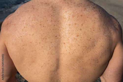 back skin with spots, freckles and moles due to the sun