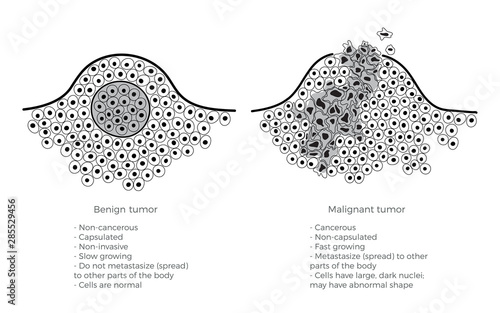 Vector  illustration of malignant and benign tumor