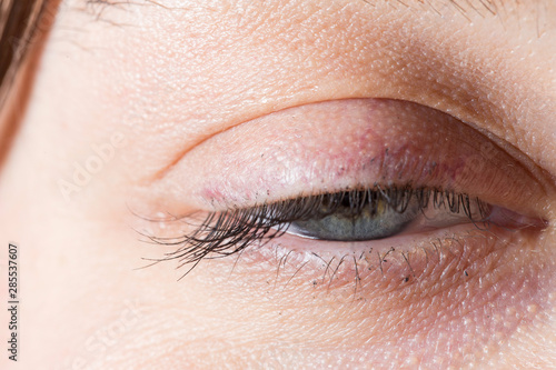 Closeup of female eye with ptosis: drooping eyelid, amblyopia condition called lazy eye. photo