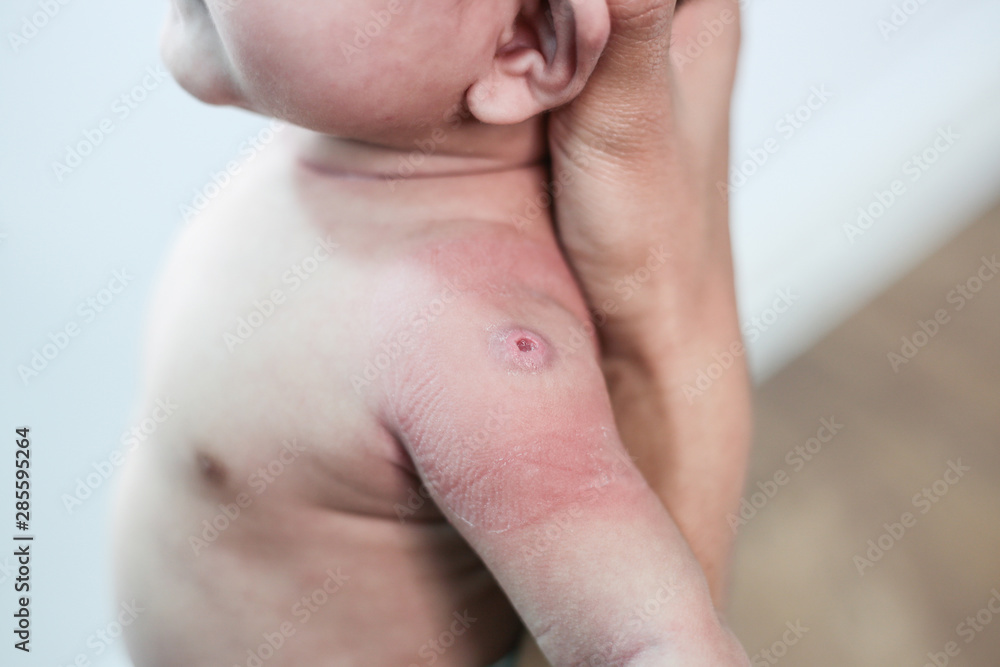 Newborn baby with red spots due to injection Newborn baby with red spots due to injection