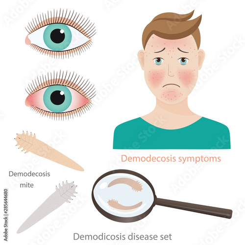 Vector set of medical illustrations with human demodicosis di