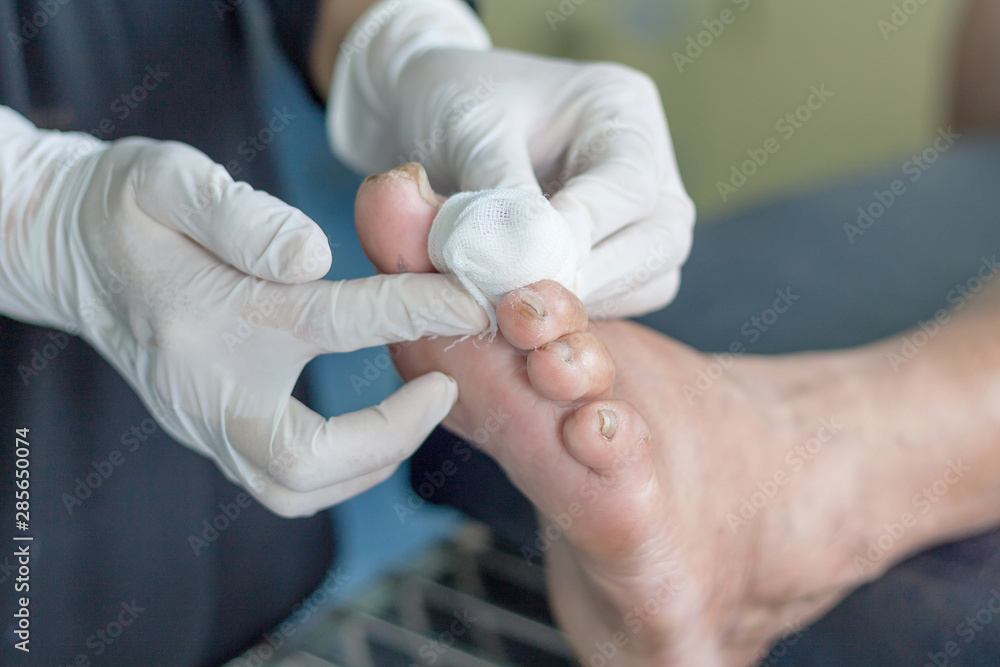 diabetes foot ulcers diabetes foot ulcers