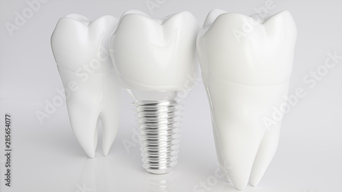 An implant compared to healthy teeth - 3d rendering