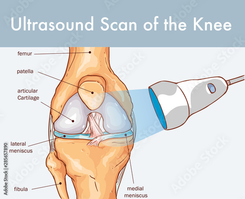  Vector illustration of a Ultrasound Scan of the Knee