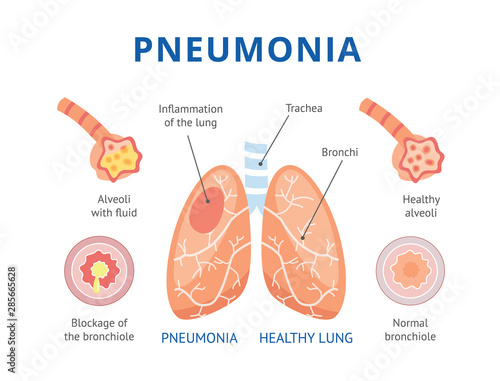 The lungs are healthy and diseased lungs with pneumonia. photo