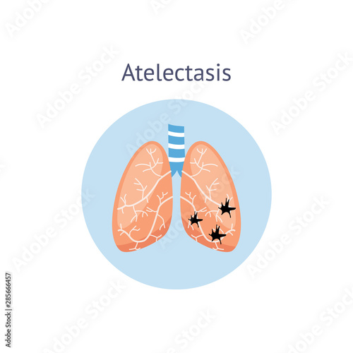 Atelectasis a medical scheme of lung disease vector illustration isolated.