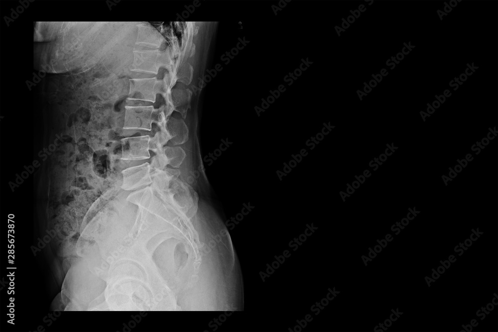 x-ray image of a woman (right side)  show  L-S spine AP and Lateral and blank area at right side.  Spinal Stenosis or vertebral stenosis or Lumbar Degenerative Spinal Canal Stenosis.