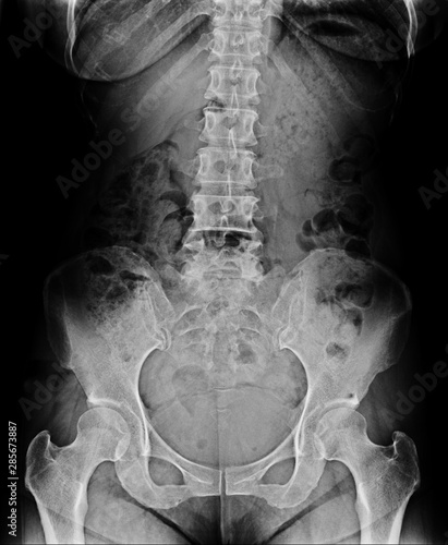 x-ray image of a woman (front side)  show  L-S spine AP and Lateral .  Spinal Stenosis or vertebral stenosis or Lumbar Degenerative Spinal Canal Stenosis.