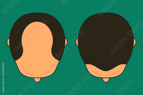 male with bald head