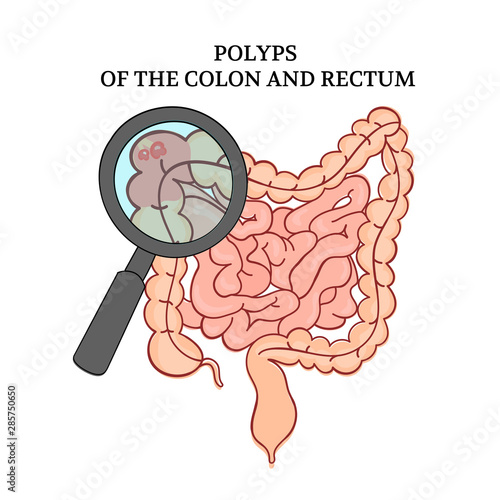 POLYPS OF THE COLON Intestines Medicine Anatomy Scheme Human Handdraw Vector Illustration