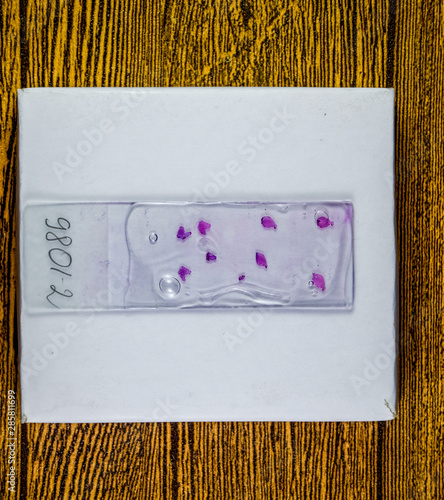 Slices of the tumor under glass. Histological examination of tumor cells for the presence of cancer photo