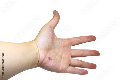 Hand with small wound,palm