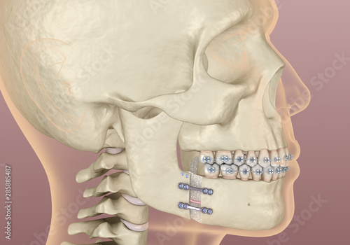 Mandibular Advancement surgery. Medically accurate dental 3D illustration. photo