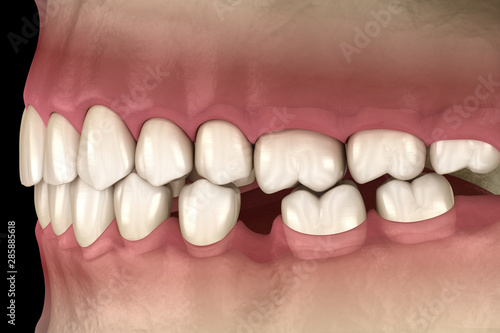 Quadro em tela Teeth shift deformatiuon after losing molar tooth