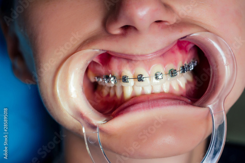 Photography female dental open mouth with fixator gel braces at the reception