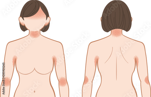 あせも・湿疹　上半身　女性