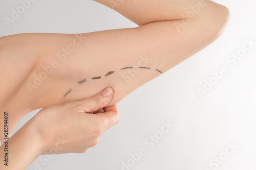 Woman with marks on arm for cosmetic surgery operation against grey background, closeup