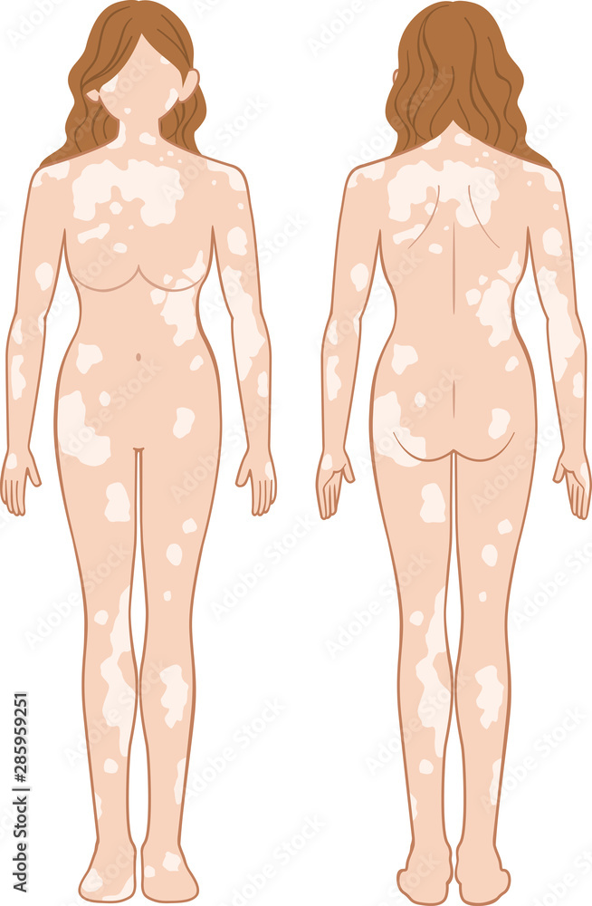 Fototapeta premium 白斑 全身 女性