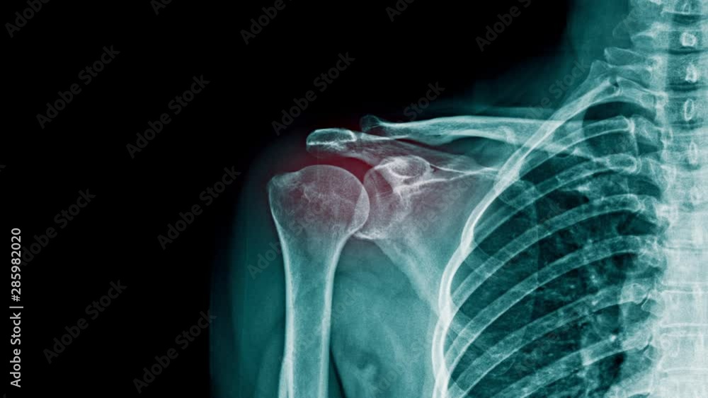Vidéo Stock shoulder pain xray footage with red hight light on