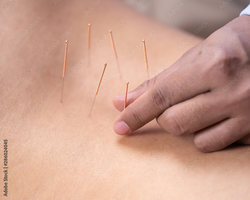 woman undergoing acupuncture treatment on back woman undergoing acupuncture treatment on back