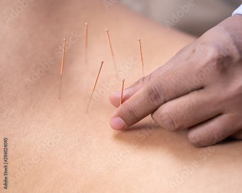 woman undergoing acupuncture treatment on back