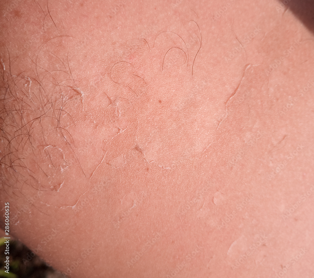 Exfoliation of the skin after sunburn. Excessive tan. Exfoliation of the skin after sunburn. Excessive tan.