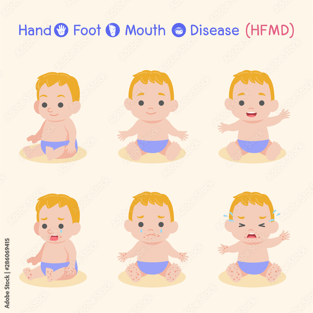 Set of baby Children infected and healthy, Boy have a Hand Foot Mouth Disease, HFMD in rain season, Medical Health care concept, cartoon character vector Info-graphic. Set of baby Children infected and healthy, Boy have a Hand Foot Mouth Disease, HFMD in rain season, Medical Health care concept, cartoon character vector Info-graphic.