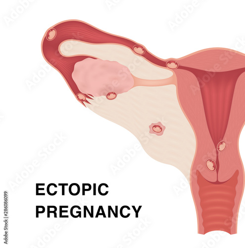 Ectopic pregnancy. Vector realistic medical illustration with inscriptions. Female reproductive organs. Frontal view in a cut. photo