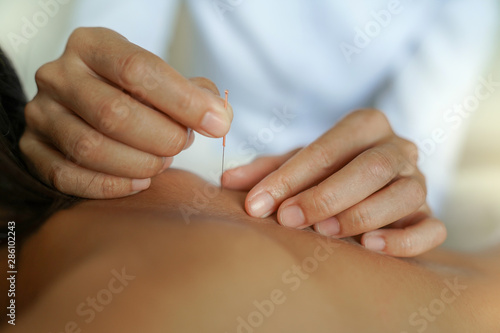 Closeup of hand performing acupuncture therapy young Asian man s back