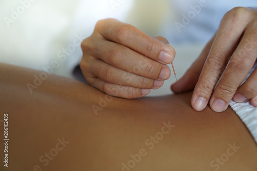 Closeup of hand performing acupuncture therapy young Asian man's back
