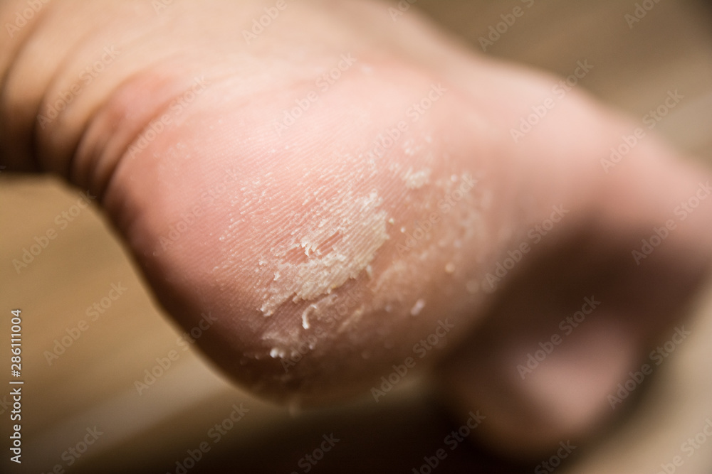 Fototapeta premium heel disease close up