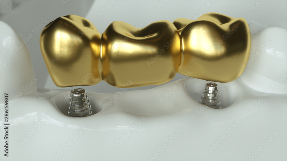 Implants with golden dental bridge - 3d rendering Implants with golden dental bridge - 3d rendering