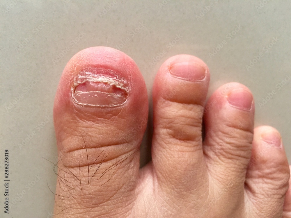 Close up new toenail after extracted Close up new toenail after extracted