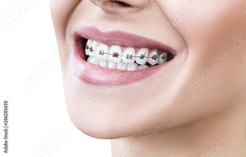 Young woman smiling with braces on teeth.