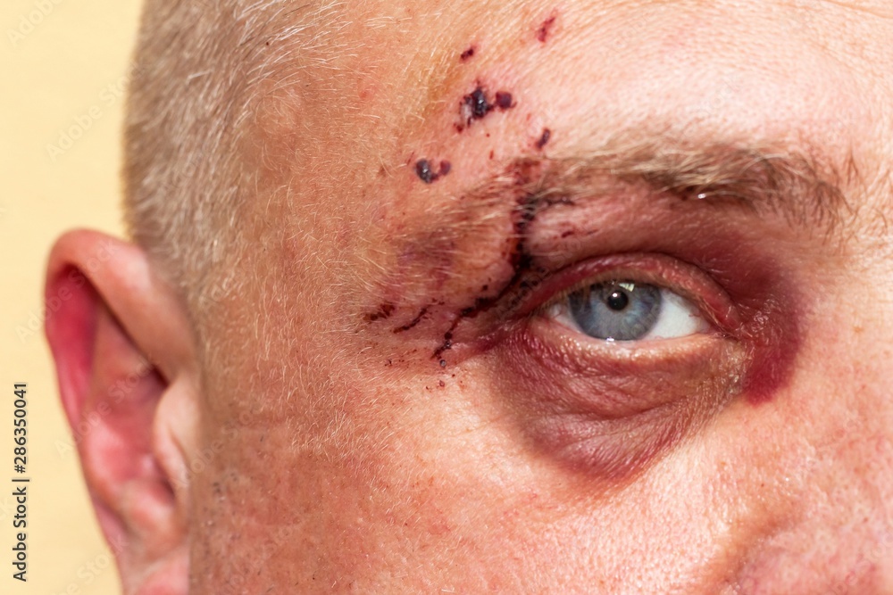 Naklejka premium Male eye with a large purple bruise. Biting dog on face. Eye injury. Large bruising on the male eye. Treatment of injuries. Boxer eye.