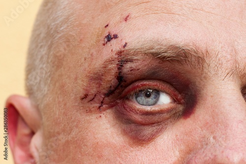 Male eye with a large purple bruise. Biting dog on face. Eye injury. Large bruising on the male eye. Treatment of injuries. Boxer eye.