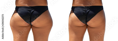 Before and after treatment to reduce cellulite on the hips and in the buttocks