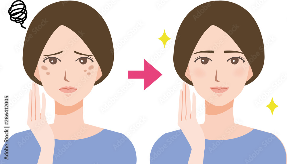 女性 しみ ビフォーアフター 美容イラスト Stock Vector Adobe Stock