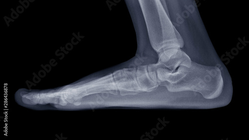 Film X-ray foot radiograph show Flat foot deformity (pes planus or fallen arches) and abnormal union of tarsal bone( Calcaneonavicular coalition). The patient has foot,ankle pain ankle problem 