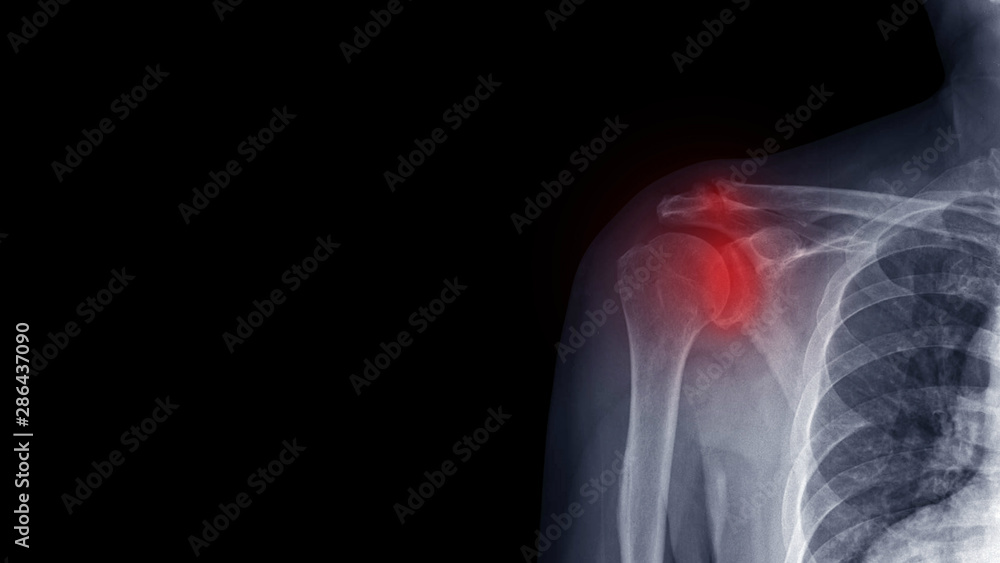 Film X ray shoulder radiograph show degenerative osteoarthritis disease