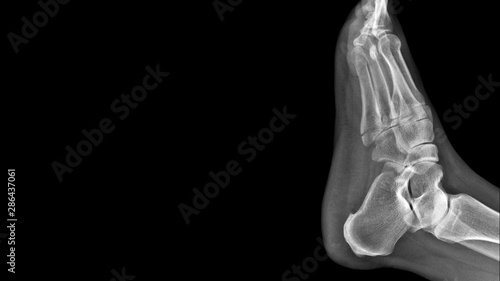 Film foot X ray radiograph show toe bone broken ( base of metatarsal fracture or Jones fracture ) from sport injury. The patient has foot pain and swelling. Medical imaging concept 