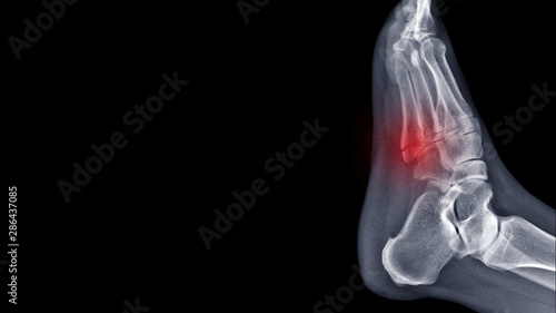 Film foot X ray radiograph show toe bone broken ( base of metatarsal fracture or Jones fracture ) from traffic accident. Highlight on fracture site and painful area. Medical imaging concept 