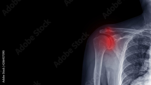 Film X ray shoulder radiograph show degenerative osteoarthritis disease of glenohumeral and acromioclavicular joint (OA shoulder disorder). Red highlight on stiffness and painful area. Medical concept photo