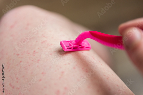 фотографія After shaving legs irritation with razor.