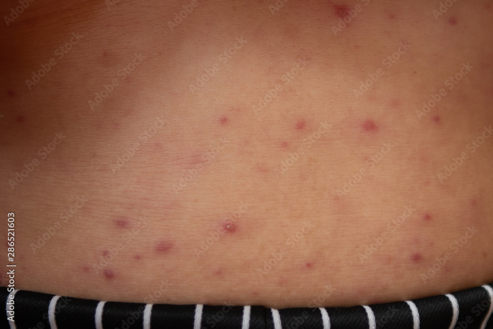 Pustules caused by viral infections or chickenpox disease Pustules caused by viral infections or chickenpox disease