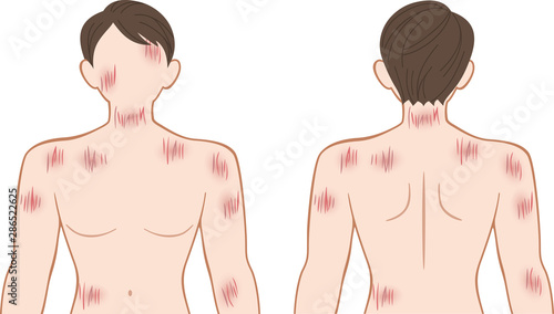 ひっかき傷　上半身　男性