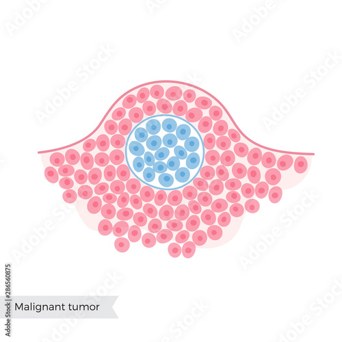 Vector isolated illustration of benign tumor 
