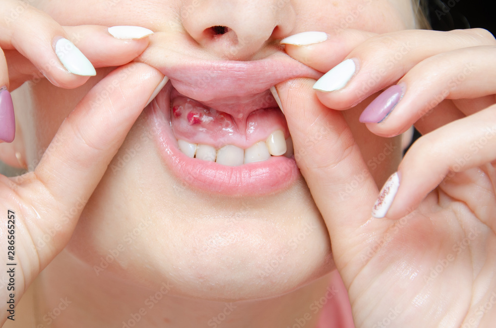 Closeup of gum with cyst or purulent flux. Disease of the gums and